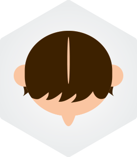 M형 탈모