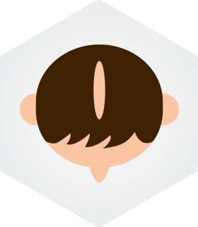 O형 탈모